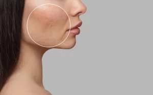 Anticoncepcionais para acne, eles existem?